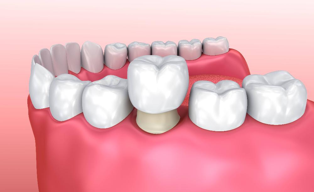 dental crown boulder co