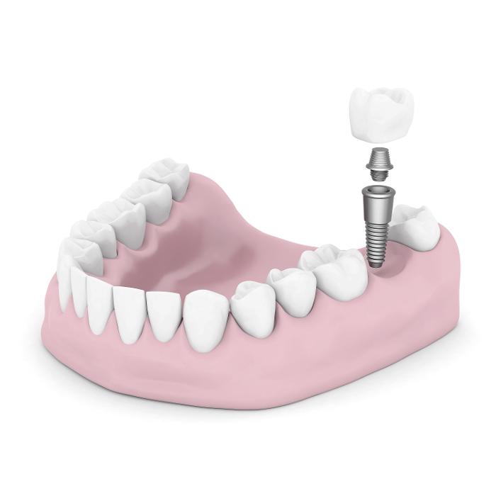 dental implants boulder co