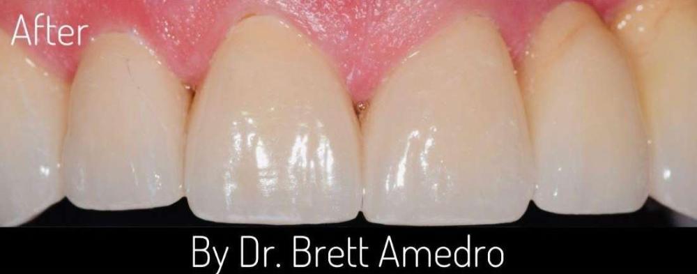 bright smile after treatment | veneers before and after boulder co