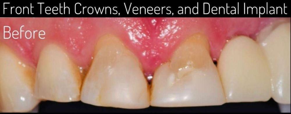 before dental treatment | veneers before and after boulder co