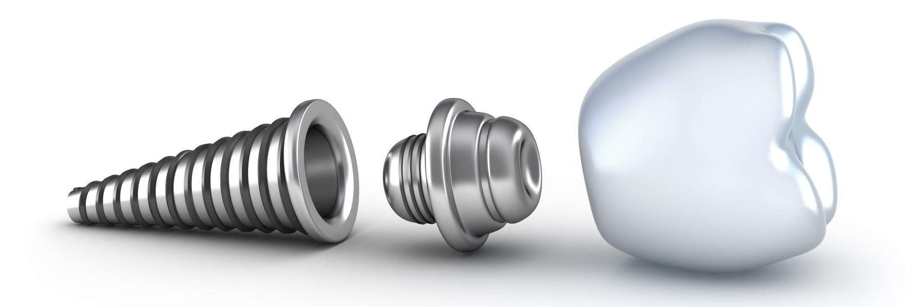 boulder co dental implants