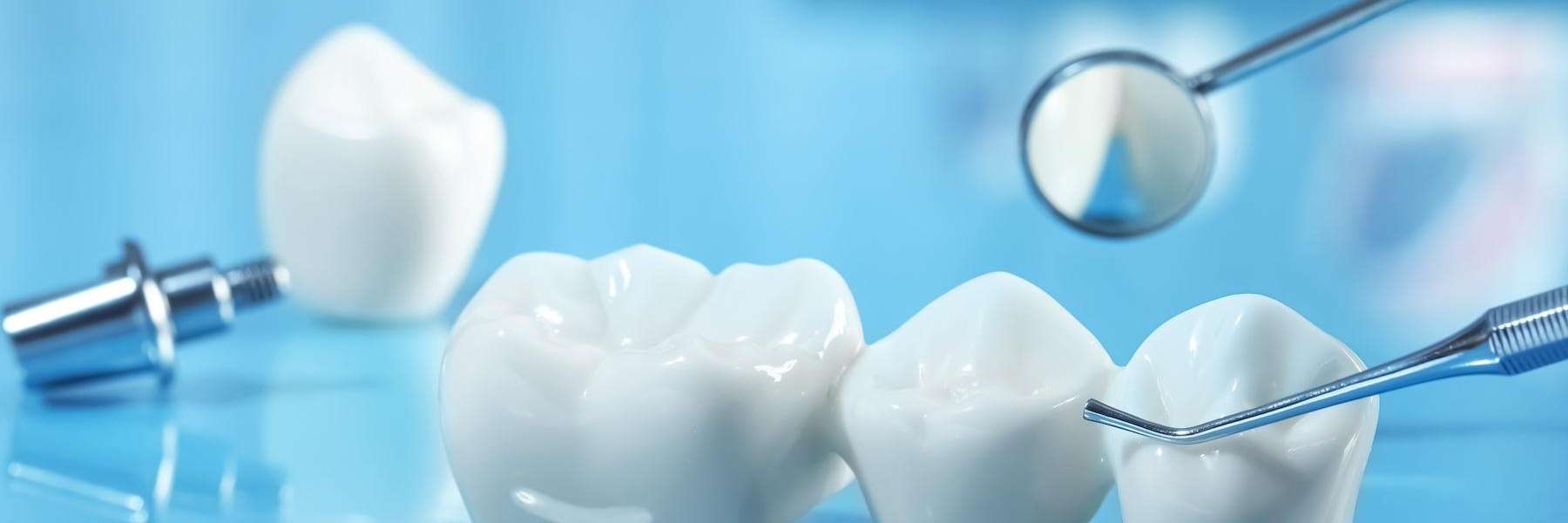 An image of Porcelain Veneers in Boulder, CO