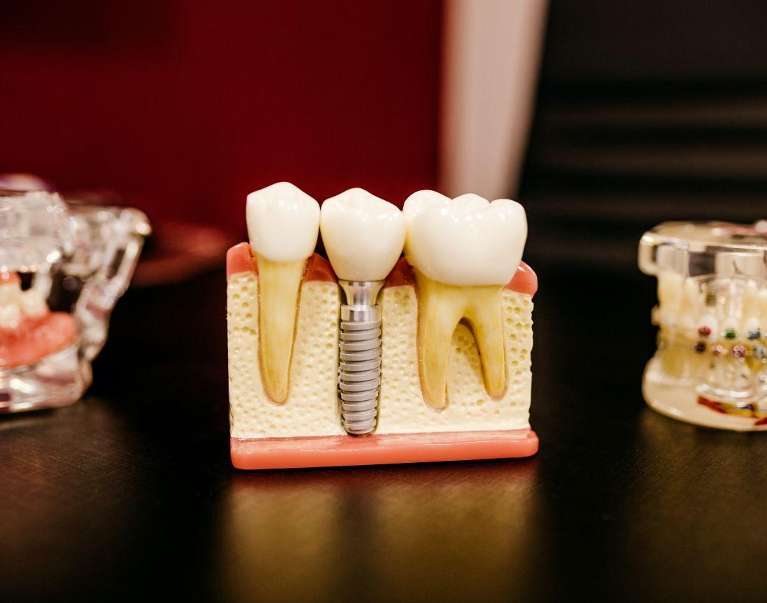 A graphic image depicting Dental Implants in Boulder, CO