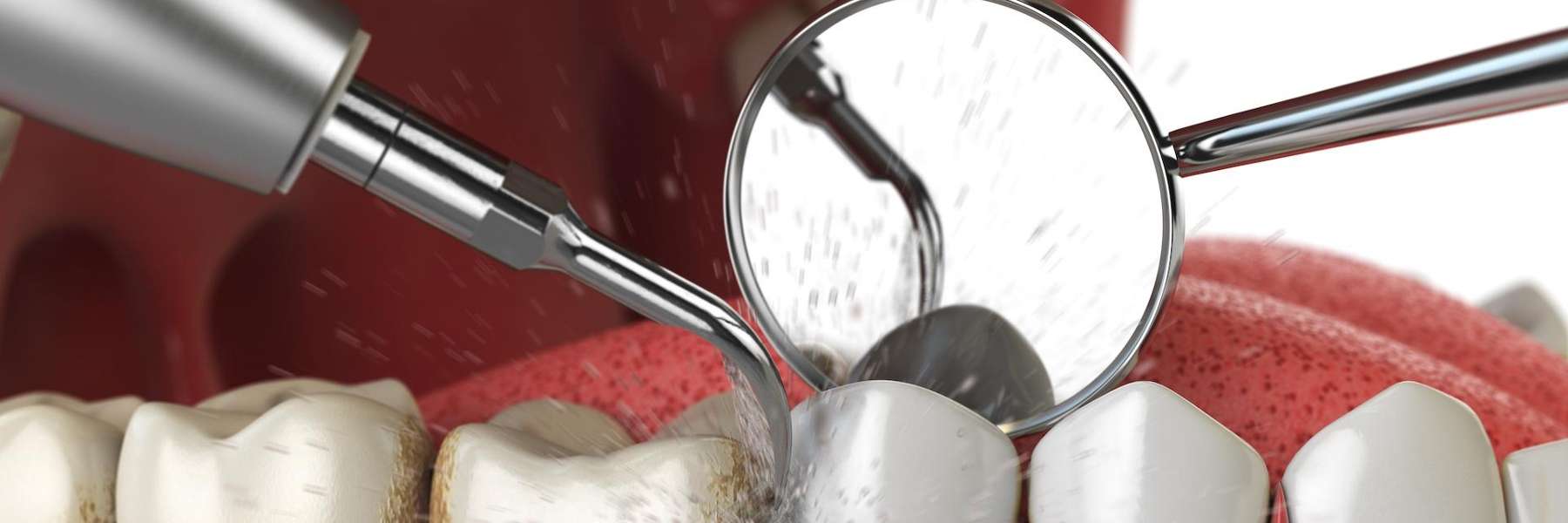 image of dental cleaning | Boulder Dentist