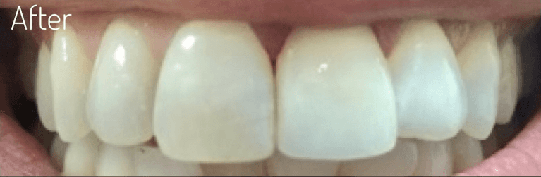 dental crowns boulder co