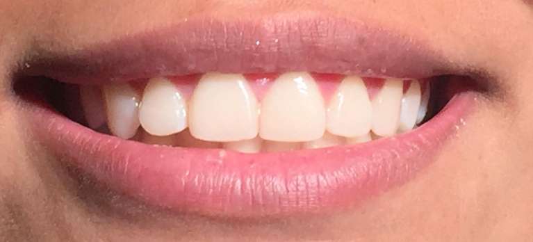 Cosmetic-Dentistry-After-Image