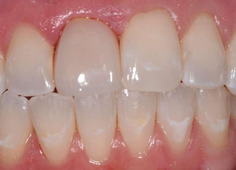 Dental Crowns in Boulder- After Photo