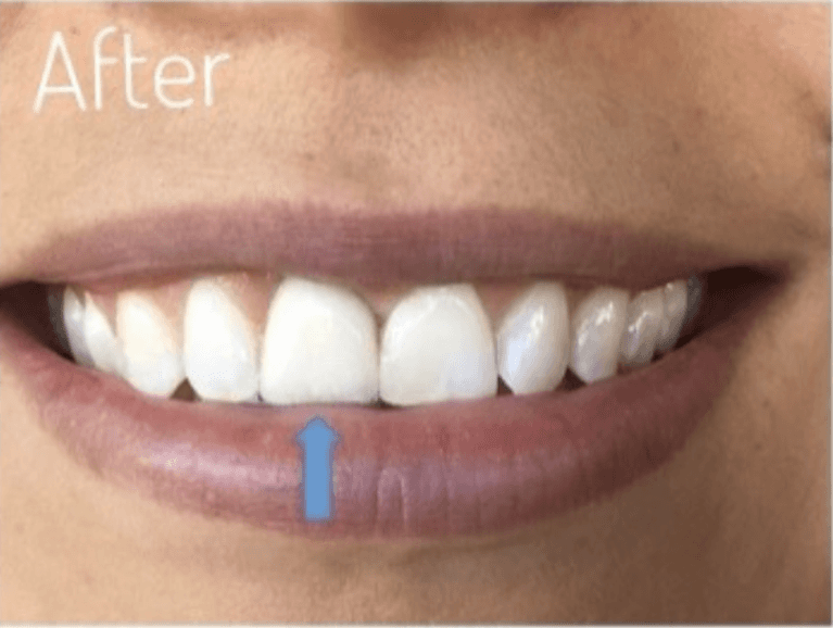 dental implants in boulder