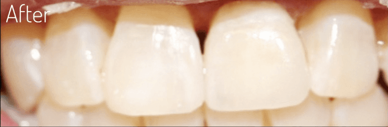 dental implant boulder co
