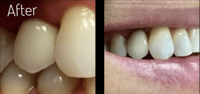 dental implants in boulder co