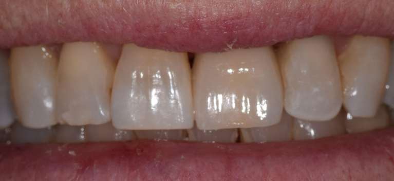 Implants in Boulder- After Photo