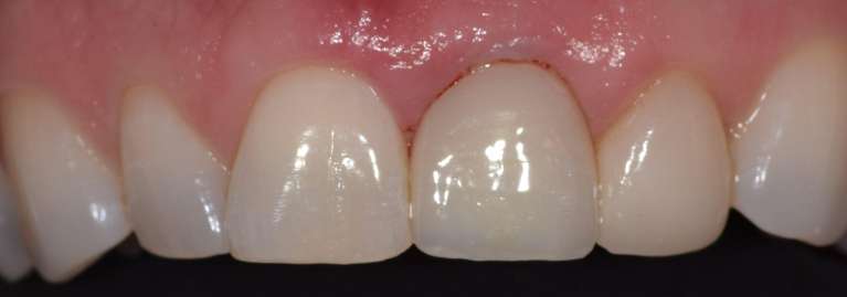 Dental Implants in Boulder- After Photo