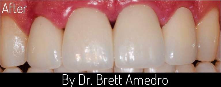 veneers in boulder co