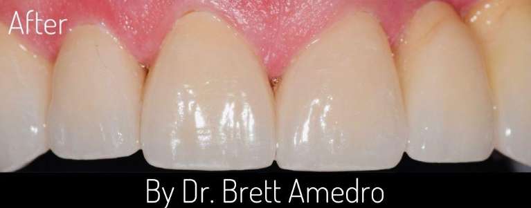 dental implants boulder co