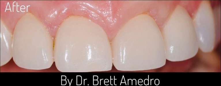 Veneers-After-Image