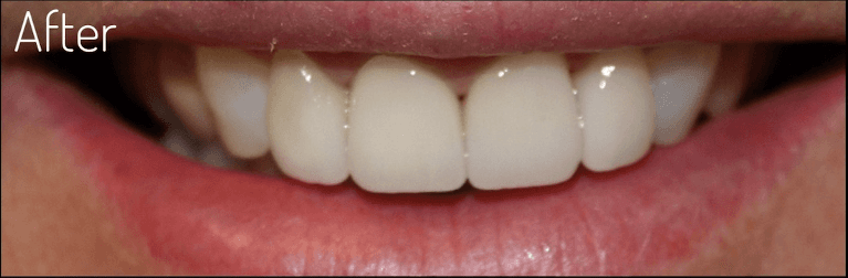 Front-Teeth-Crowns-After-Image