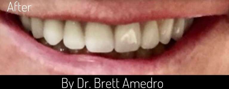 all on four implants in boulder