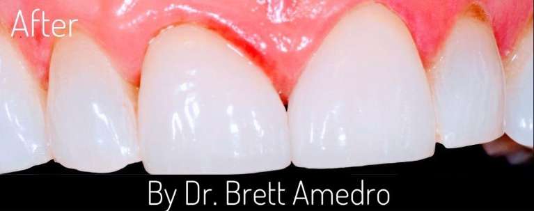 dental implants in boulder co