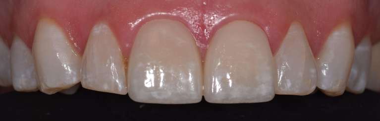 Veneers-After-Image