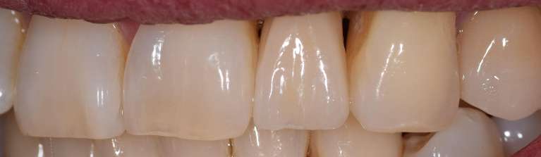 Implants Boulder- After Photo