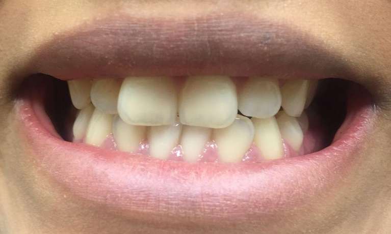 Cosmetic-Dentistry-Before-Image