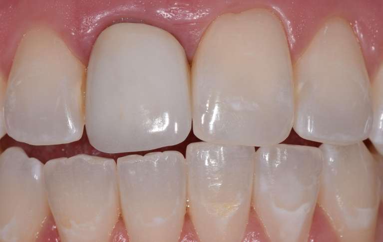Dental Crowns in Boulder- Before Photo