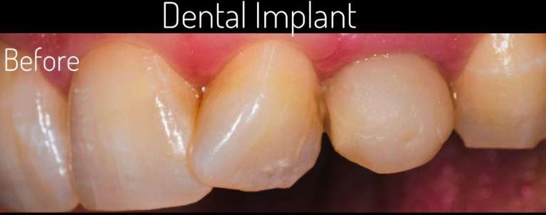 dental implant dentist boulder co