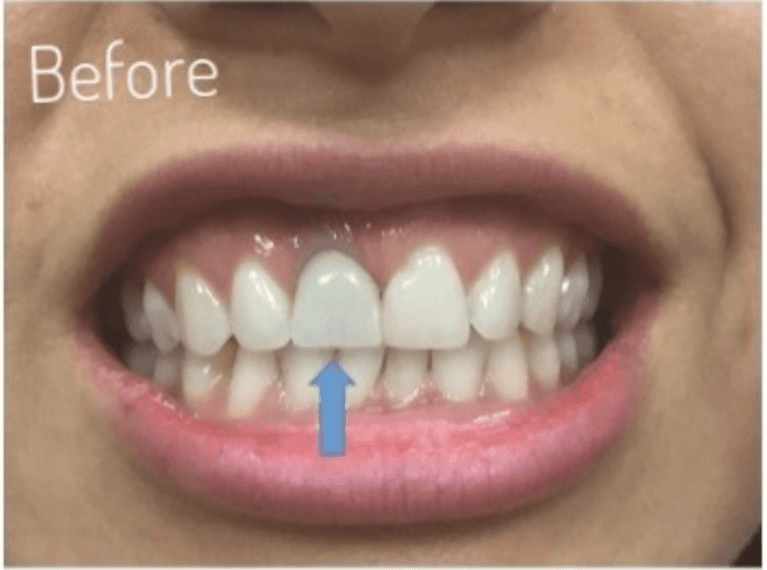 implant dentist in boulder