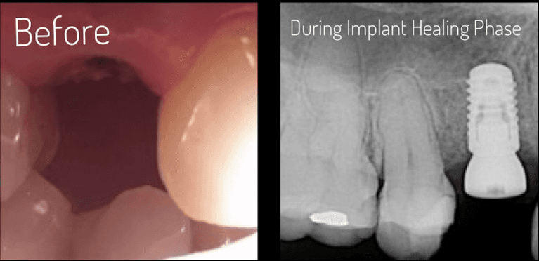dental implant
