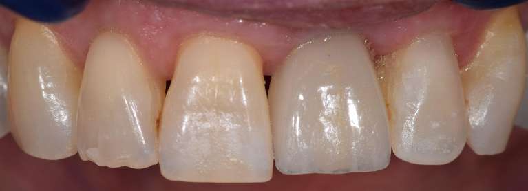 Implants in Boulder- Before Photo