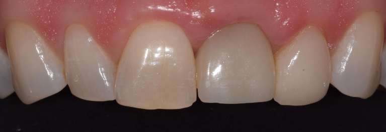 Dental Implants in Boulder- Before Photo