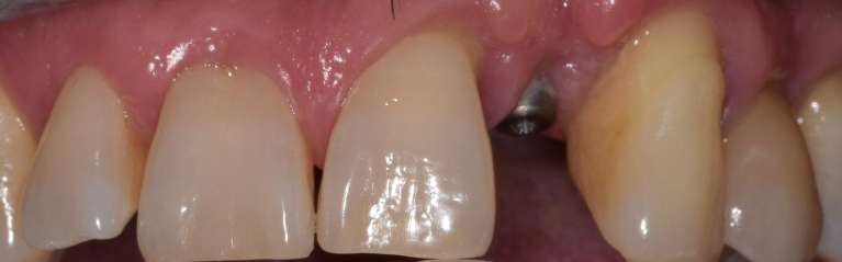 Implants Boulder- Before Photo