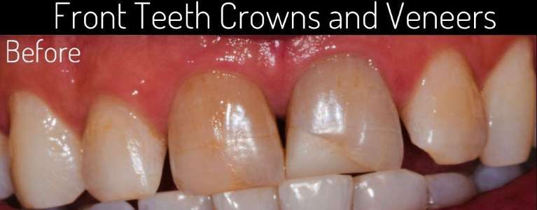 dental crown boulder co