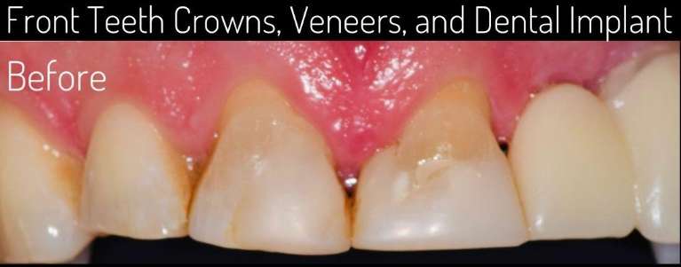 dental crowns boulder