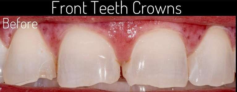 Veneers-Before-Image