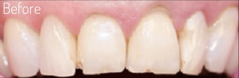 Front-Teeth-Crowns-Before-Image