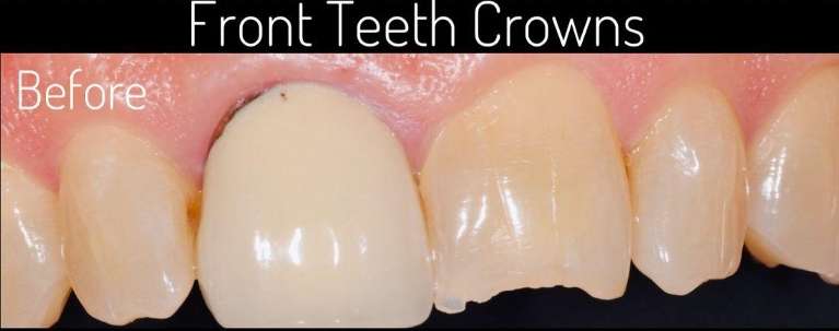 front tooth crowns boulder co