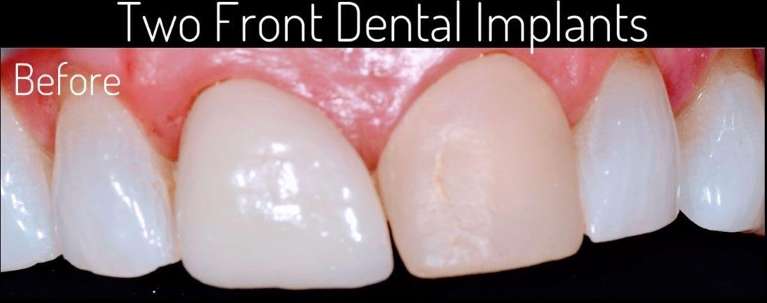dental implant specialist boulder co