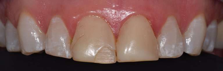 Veneers-Before-Image